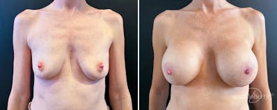Breast Augmentation Before & After Gallery - Patient 209354 - Image 1