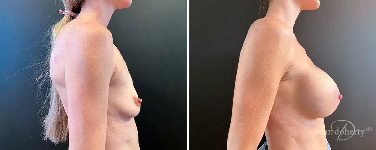 Breast Augmentation  Before & After Gallery - Patient 209354 - Image 3