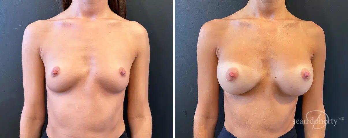 Breast Augmentation Before & After Gallery - Patient 336511 - Image 1