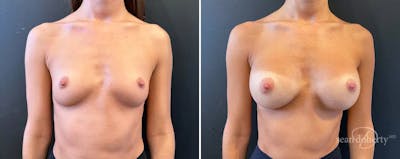 Breast Augmentation Before & After Gallery - Patient 336511 - Image 1