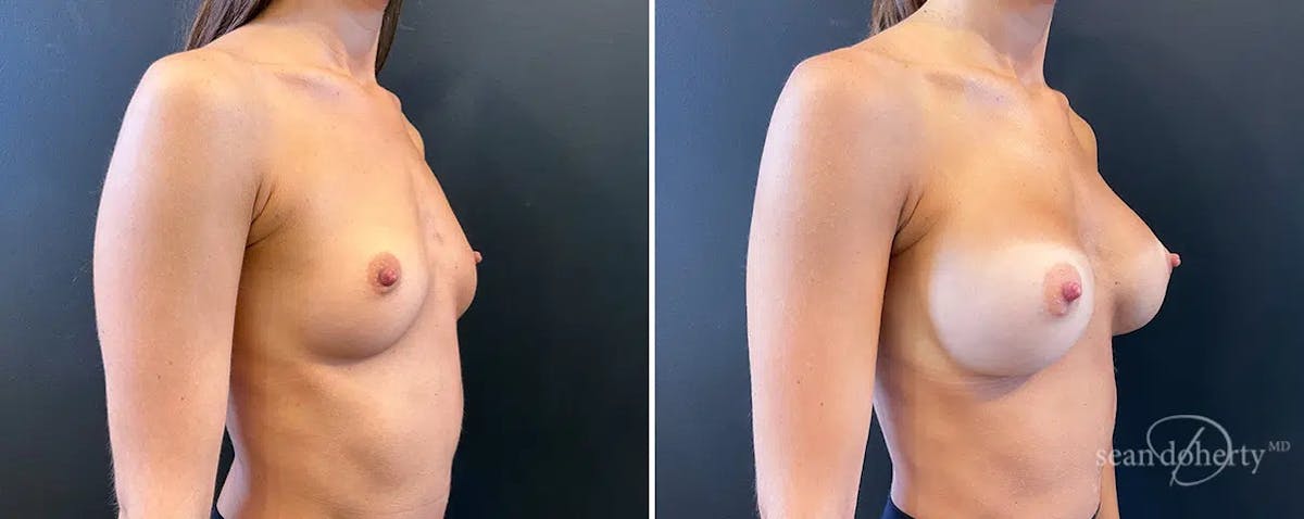 Breast Augmentation Before & After Gallery - Patient 336511 - Image 2