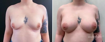Breast Augmentation Before & After Gallery - Patient 197369 - Image 1