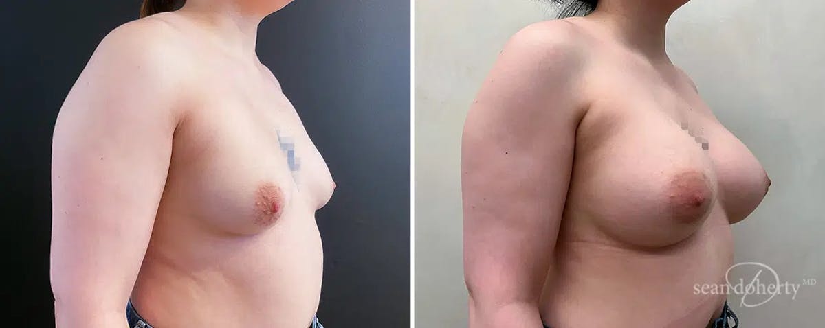 Breast Augmentation  Before & After Gallery - Patient 197369 - Image 2