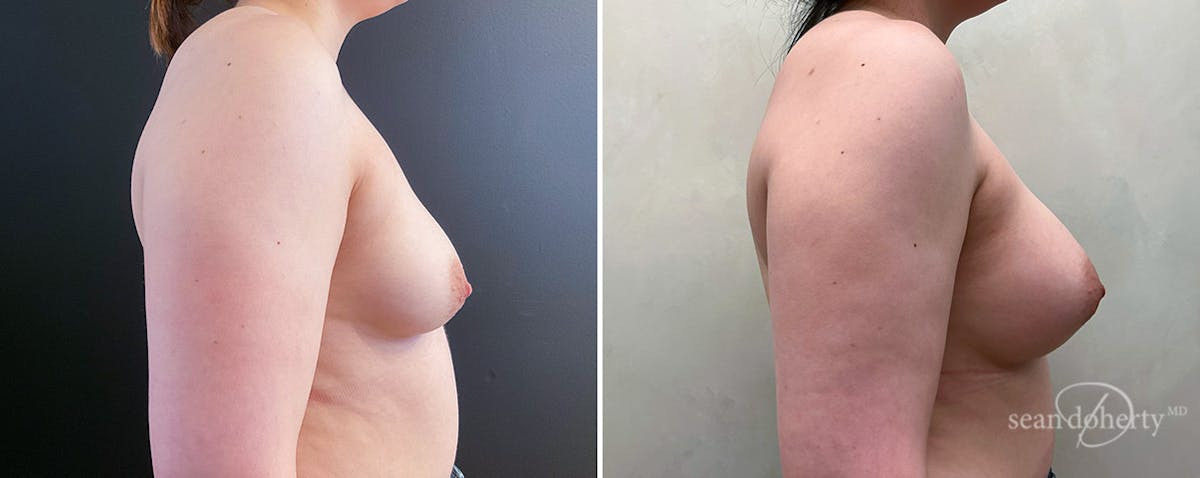Breast Augmentation  Before & After Gallery - Patient 197369 - Image 3