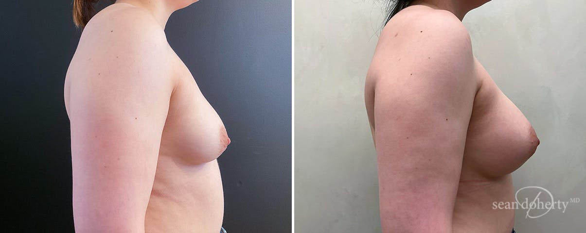 Breast Augmentation Before & After Gallery - Patient 197369 - Image 3