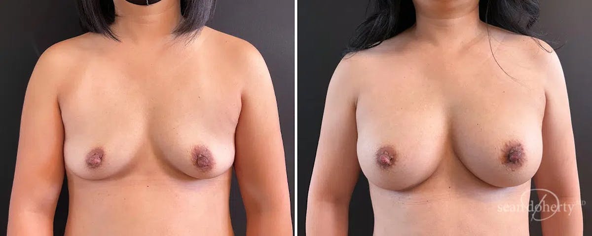 Breast Augmentation Before & After Gallery - Patient 197676 - Image 1
