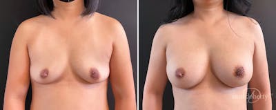 Breast Augmentation Before & After Gallery - Patient 197676 - Image 1