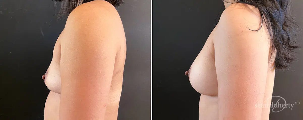 Breast Augmentation Before & After Gallery - Patient 197676 - Image 3