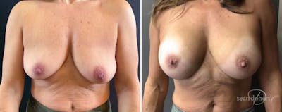Breast Augmentation Before & After Gallery - Patient 229731 - Image 1