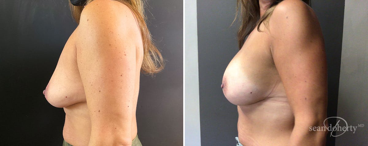 Breast Augmentation  Before & After Gallery - Patient 229731 - Image 3