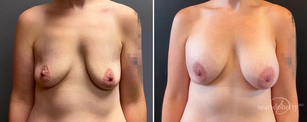 Breast Augmentation Before & After Gallery - Patient 398555 - Image 1