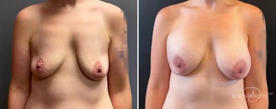 Breast Augmentation Before & After Gallery - Patient 398555 - Image 1