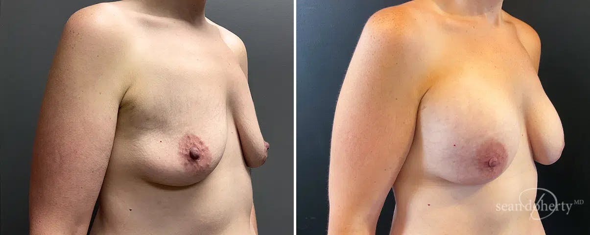 Breast Augmentation Before & After Gallery - Patient 398555 - Image 2