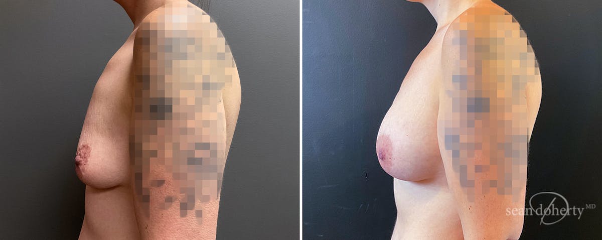 Breast Augmentation Before & After Gallery - Patient 398555 - Image 3