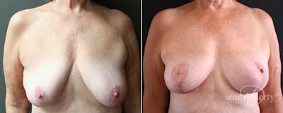 Breast Lift Before & After Gallery - Patient 116281 - Image 1