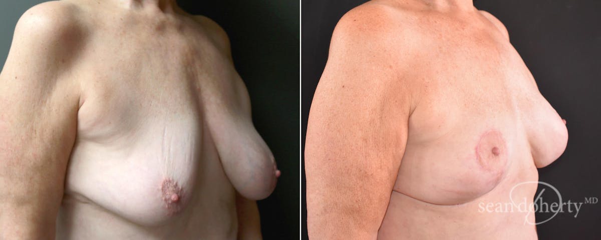 Breast Lift Before & After Gallery - Patient 116281 - Image 2
