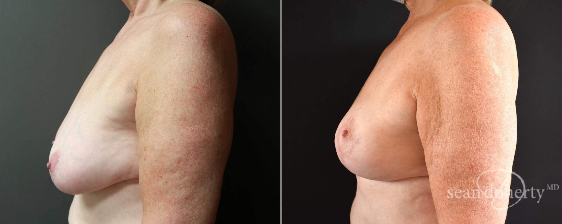 Breast Lift Before & After Gallery - Patient 116281 - Image 3