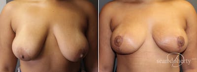 Breast Lift Before & After Gallery - Patient 130028 - Image 1