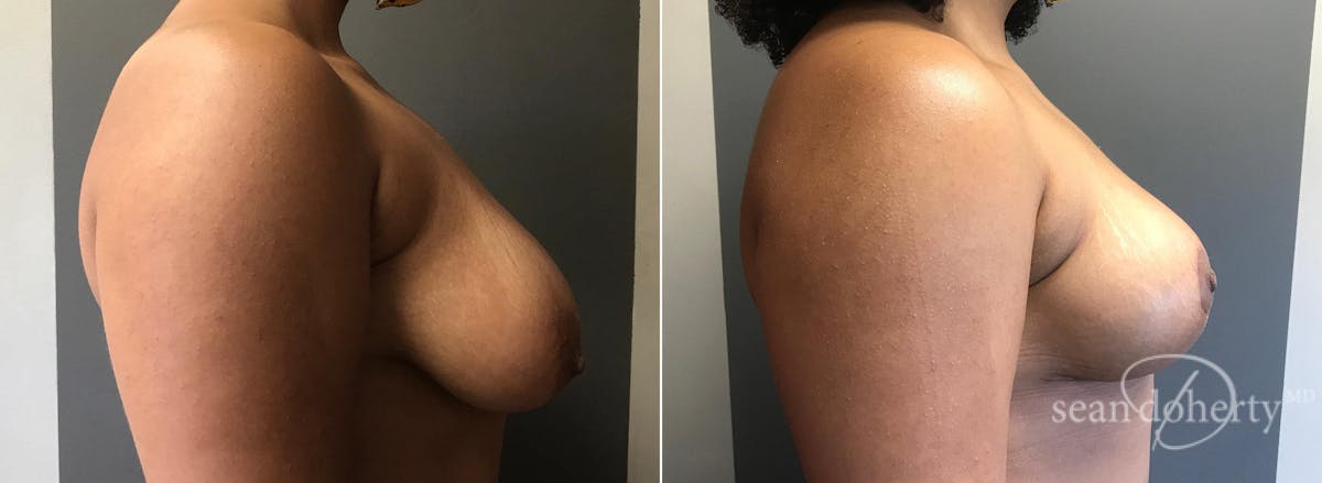 Breast Lift Before & After Gallery - Patient 130028 - Image 3