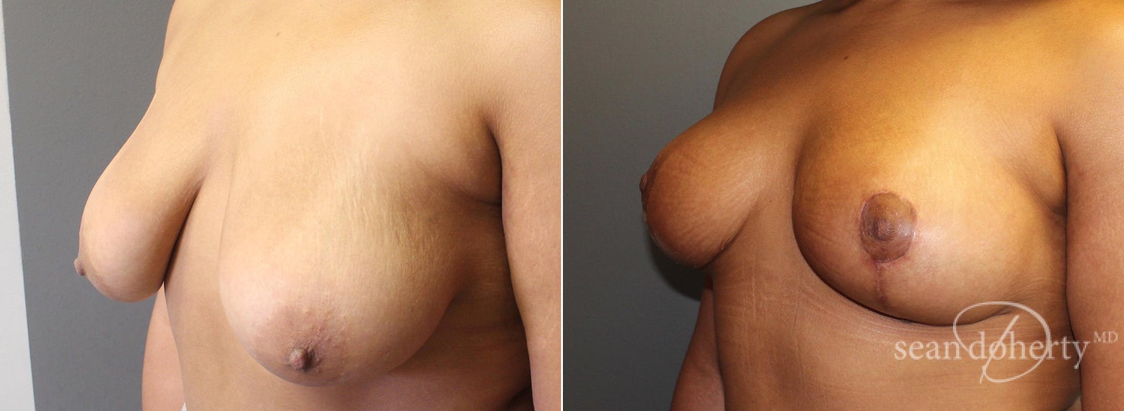 Breast Lift Before & After Gallery - Patient 130028 - Image 2