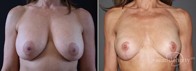 Breast Lift Before & After Gallery - Patient 298563 - Image 1