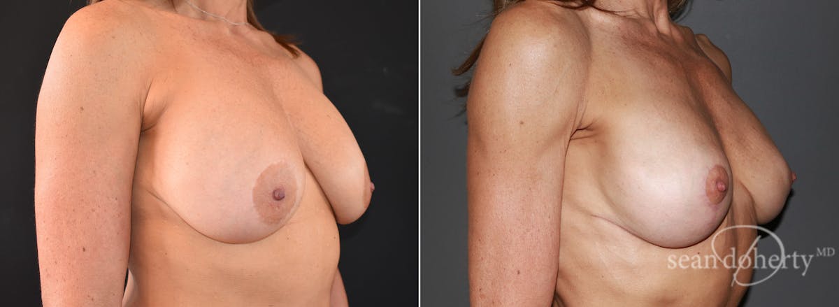 Breast Lift Before & After Gallery - Patient 298563 - Image 2