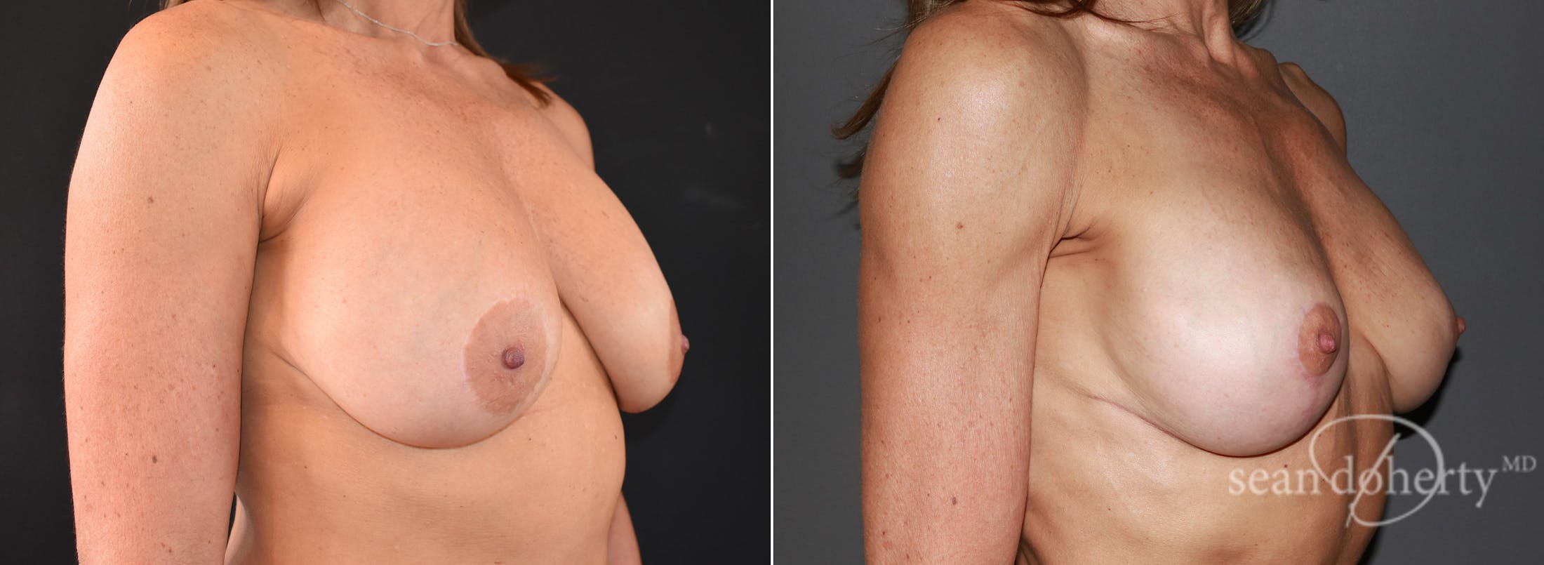 Breast Lift Before & After Gallery - Patient 298563 - Image 2