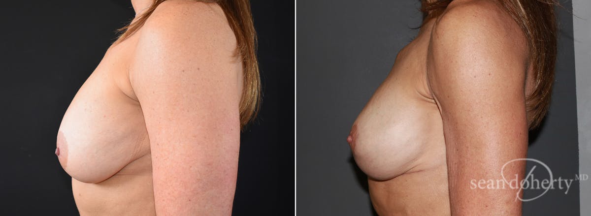 Breast Lift Before & After Gallery - Patient 298563 - Image 3