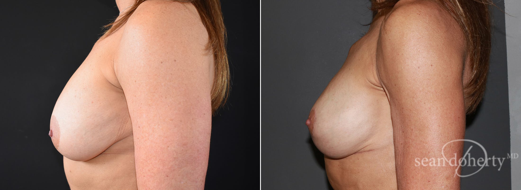Breast Lift Before & After Gallery - Patient 298563 - Image 3