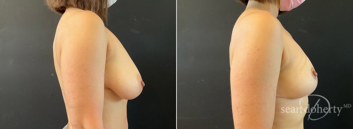 Breast Lift Before & After Gallery - Patient 172987 - Image 3