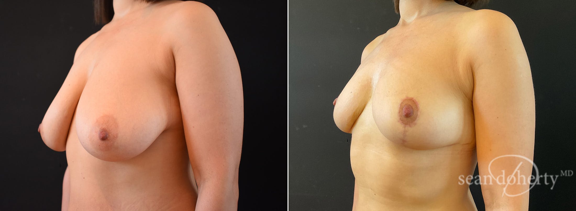 Breast Lift Before & After Gallery - Patient 172987 - Image 2
