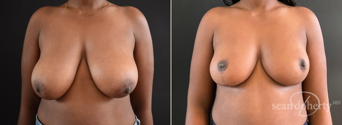 Breast Lift Before & After Gallery - Patient 389651 - Image 1