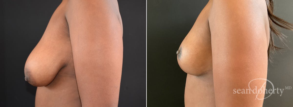 Breast Lift Before & After Gallery - Patient 389651 - Image 3