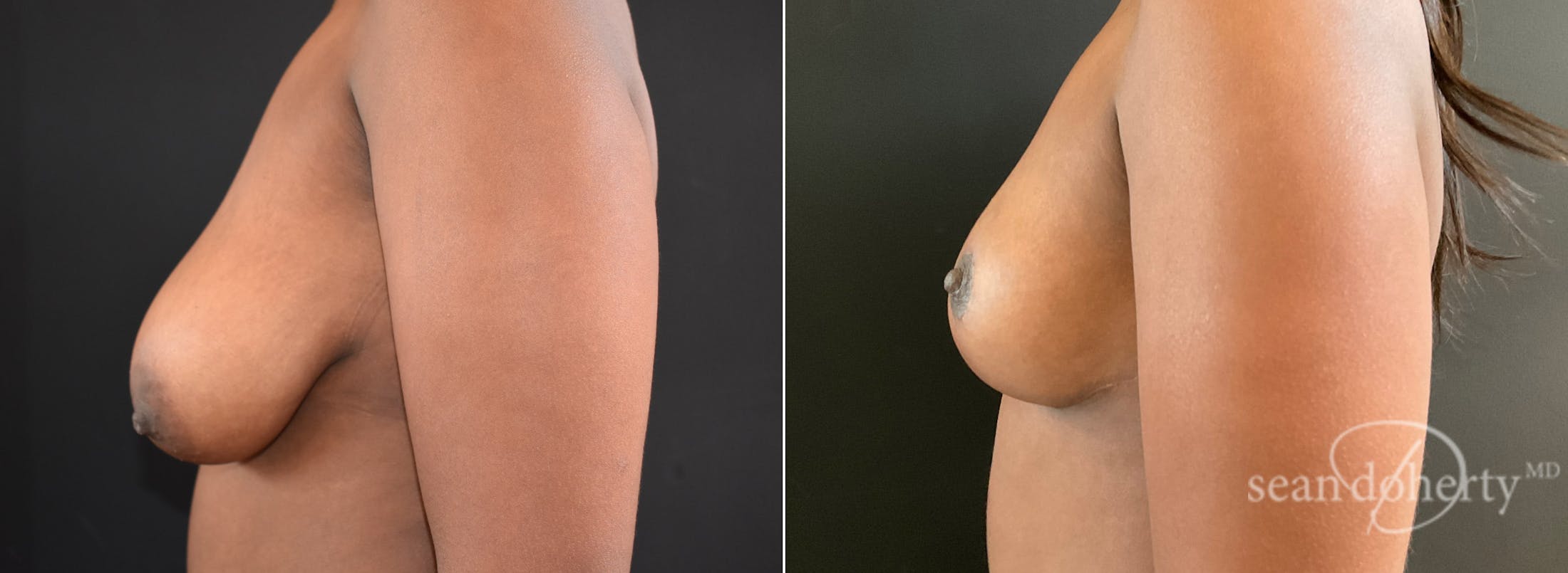 Breast Lift Before & After Gallery - Patient 389651 - Image 3