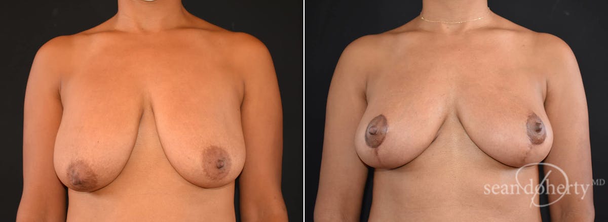 Breast Lift Before & After Gallery - Patient 285818 - Image 1