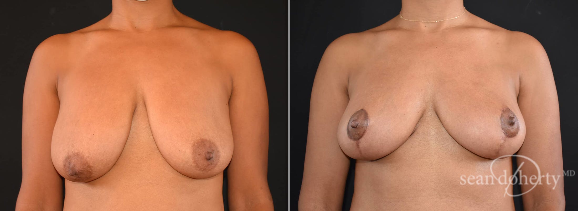 Breast Lift Before & After Gallery - Patient 285818 - Image 1