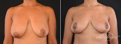 Breast Lift Before & After Gallery - Patient 285818 - Image 1