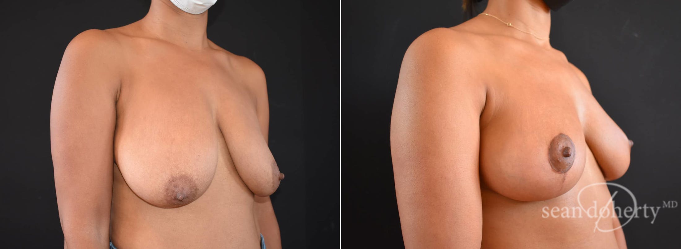 Breast Lift Before & After Gallery - Patient 285818 - Image 2