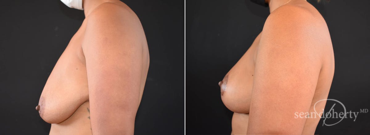 Breast Lift Before & After Gallery - Patient 285818 - Image 3