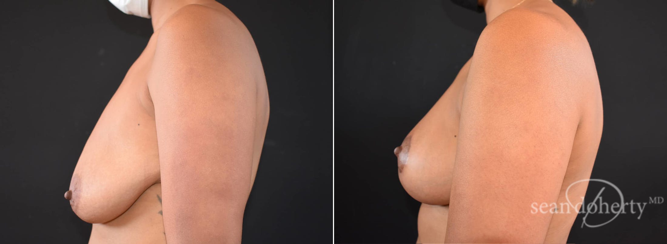 Breast Lift Before & After Gallery - Patient 285818 - Image 3