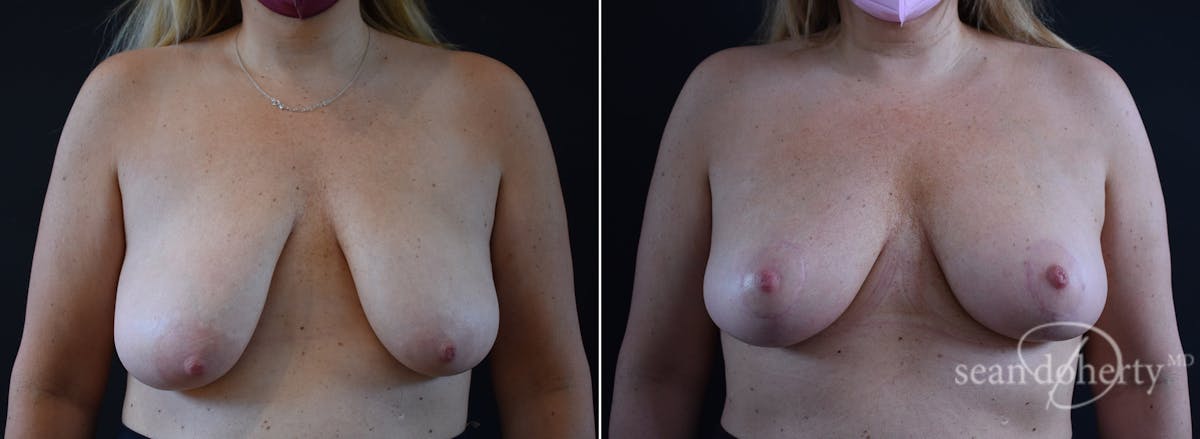 Breast Lift Before & After Gallery - Patient 503815 - Image 1