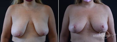 Breast Lift Before & After Gallery - Patient 503815 - Image 1
