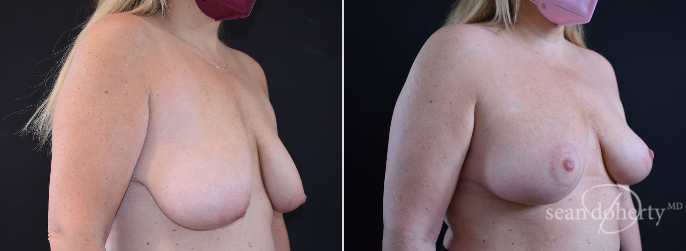 Breast Lift Before & After Gallery - Patient 503815 - Image 2