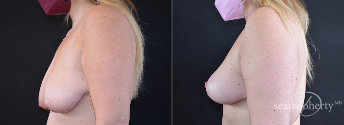 Breast Lift Before & After Gallery - Patient 503815 - Image 3