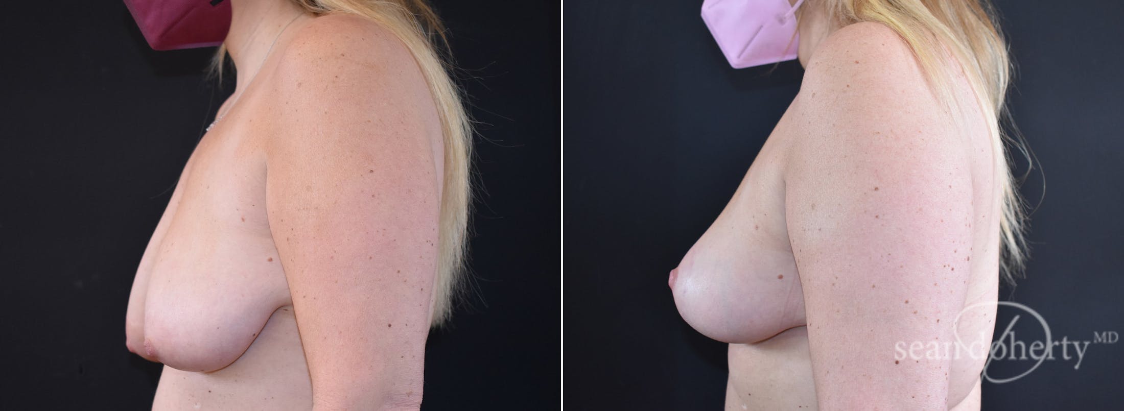Breast Lift Before & After Gallery - Patient 503815 - Image 3