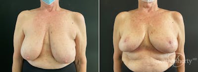 Breast Lift Before & After Gallery - Patient 280082 - Image 1