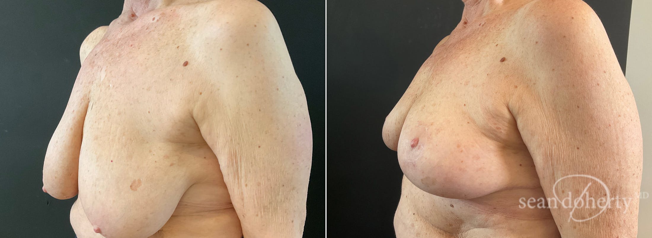 Breast Lift Before & After Gallery - Patient 280082 - Image 2