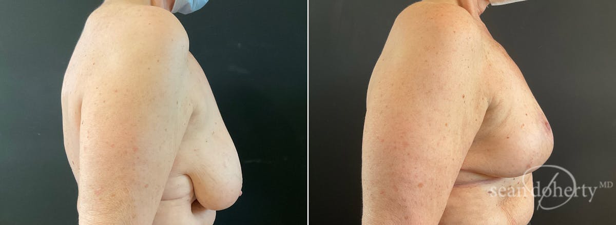 Breast Lift Before & After Gallery - Patient 280082 - Image 3
