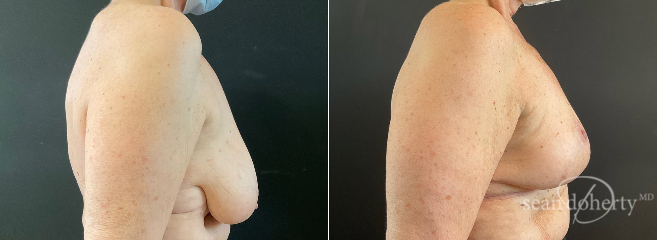 Breast Lift Before & After Gallery - Patient 280082 - Image 3