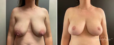 Breast Lift Before & After Gallery - Patient 301556 - Image 1